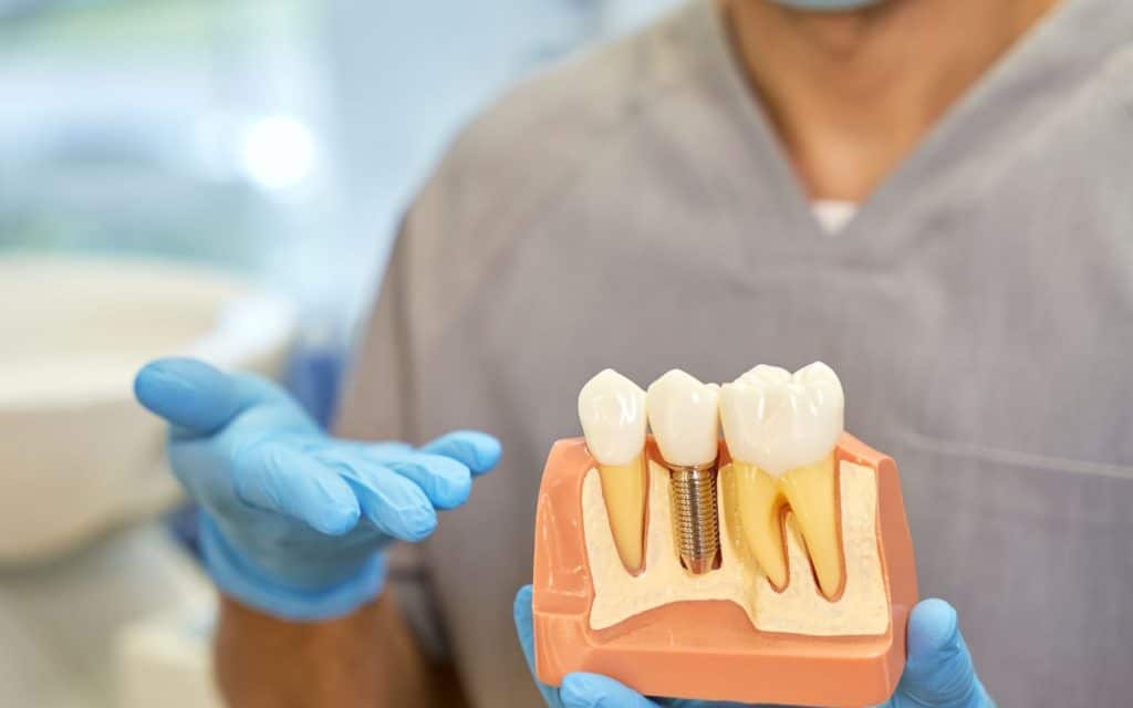 Misconception About Dental Implants